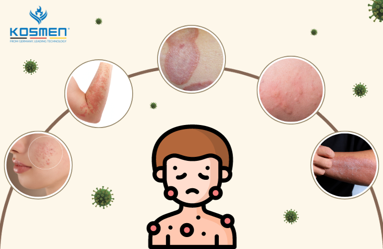 Nồm ẩm là giai đoạn dễ làm lây lan và tái phát các bệnh da liễu nhất