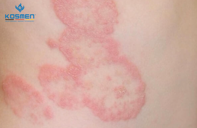 Nguyên nhân chính gây ra bệnh nấm da là do các loại virus gây bệnh