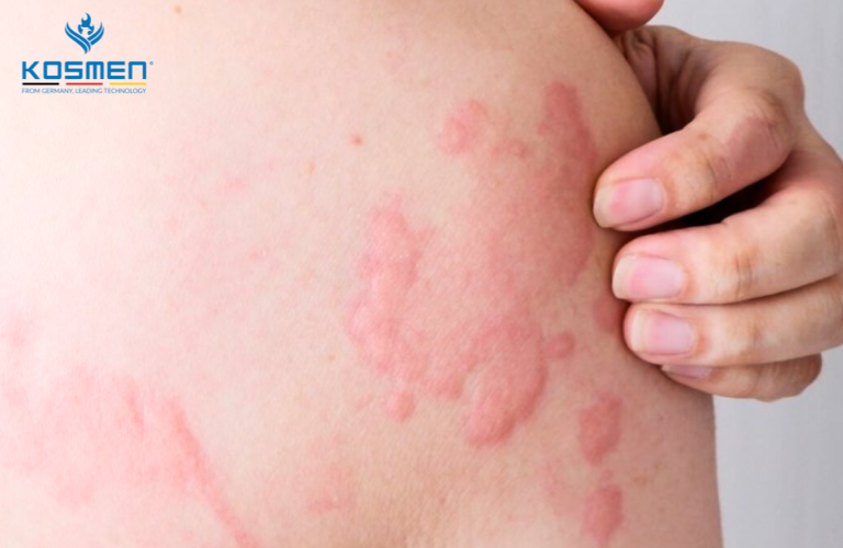 Bệnh nổi mề đay cũng xuất hiện nhiều khi thời tiết thất thường hoặc trong giai đoạn chuyển mùa