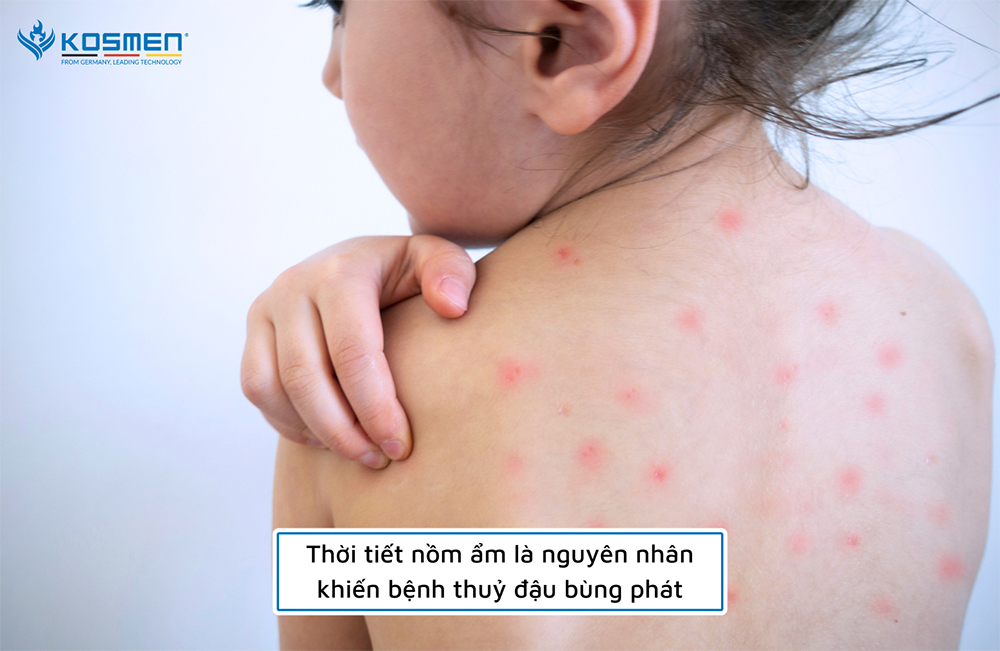 Số ca mắc bệnh thuỷ đậu thường tăng trong khoảng thời gian từ tháng 2 đến tháng 4 