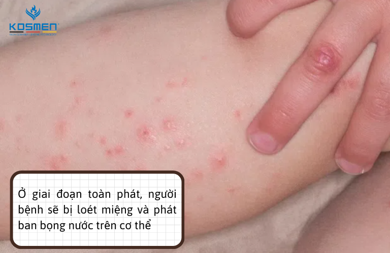 Các mụn nước sẽ xuất hiện nhiều vào giai đoạn toàn phát và sẽ giảm dần ở giai đoạn lui bệnh