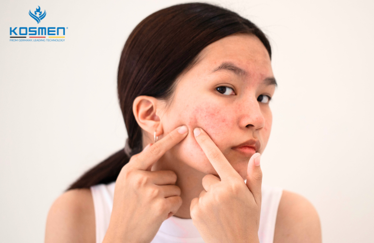 Thời tiết ẩm thấp gây bí lỗ chân lông làm mọc mụn trứng cá 