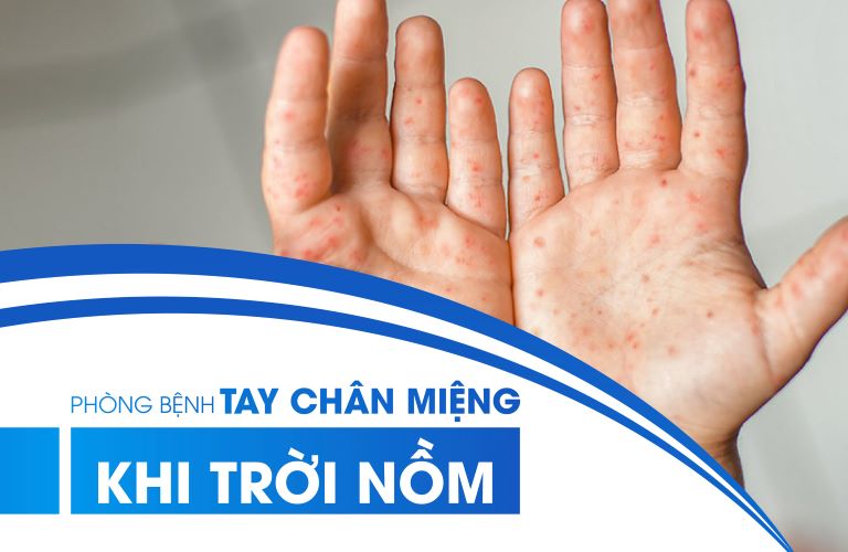 Chủ Động Phòng Bệnh Tay Chân Miệng Khi Trời Nồm Ẩm