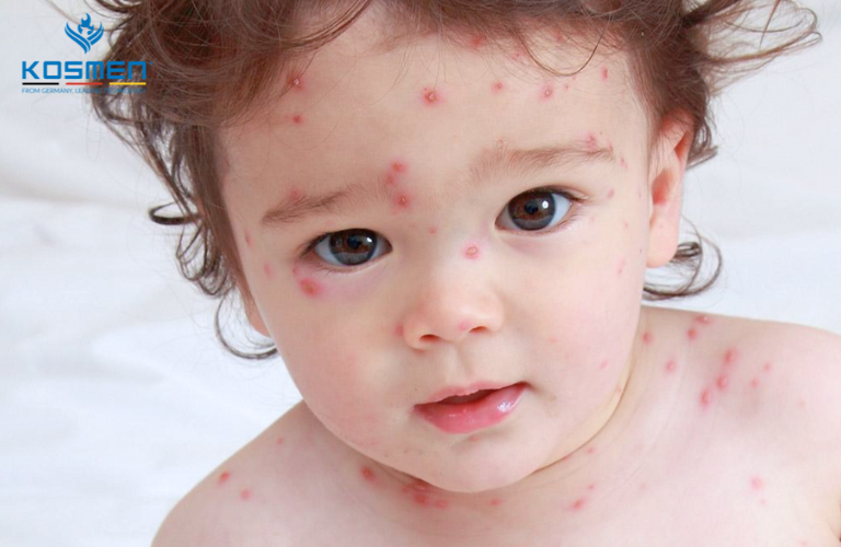 Bệnh thủy đậu có thể để lại di chứng nên cần phòng ngừa và tiêm vaccine cho đối tượng từ 12 tháng tuổi trở đi