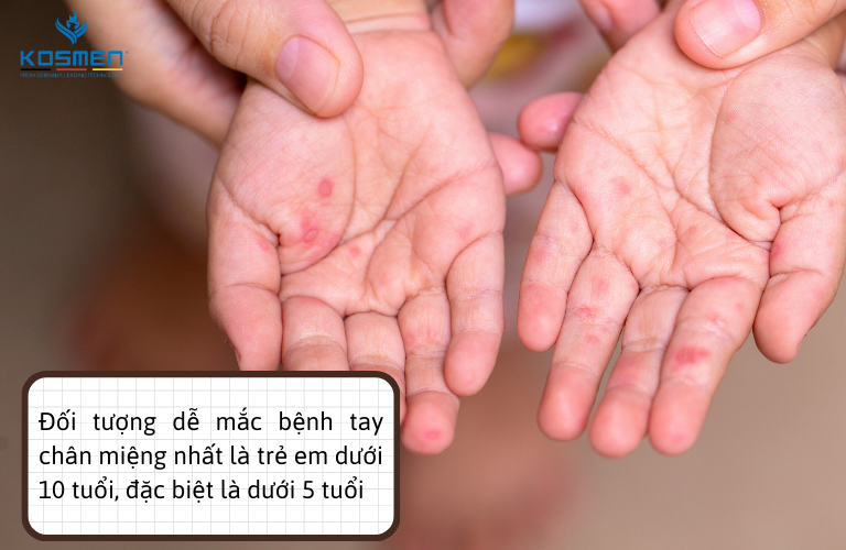 Trẻ em là đối tượng dễ mắc bệnh tay chân miệng nhất